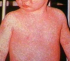 Measles in Rochdale