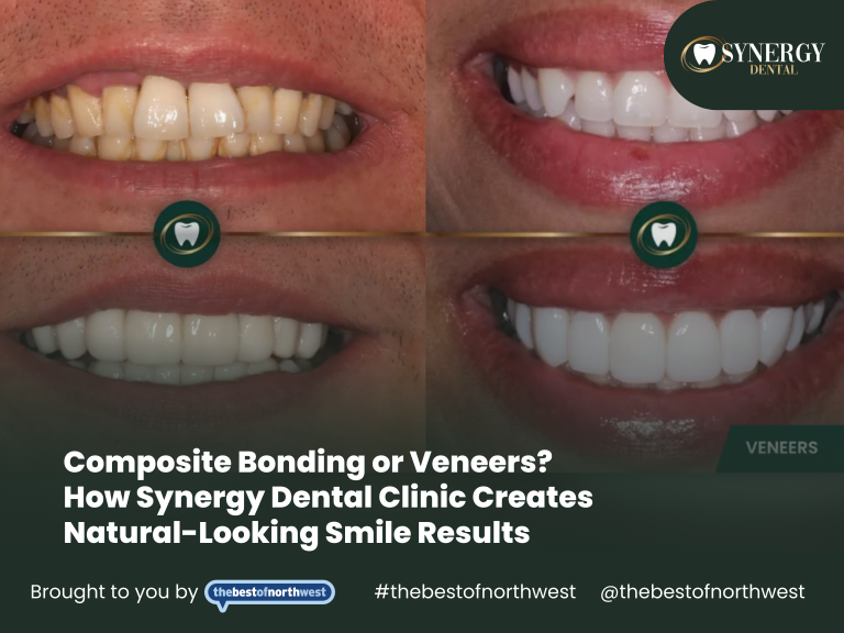 Composite Bonding or Veneers? How Synergy Dental Clinic Creates Natural-Looking Smile Results