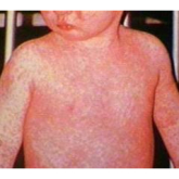 Measles in Rochdale