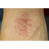 Are You Itching To Find Other Eczema Sufferers?
