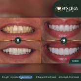 Composite Bonding or Veneers? How Synergy Dental Clinic Creates Natural-Looking Smile Results