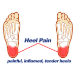 Shropshire Foot Specialists - The Telford based Heel Pain Experts