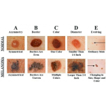Skin Cancer Awareness