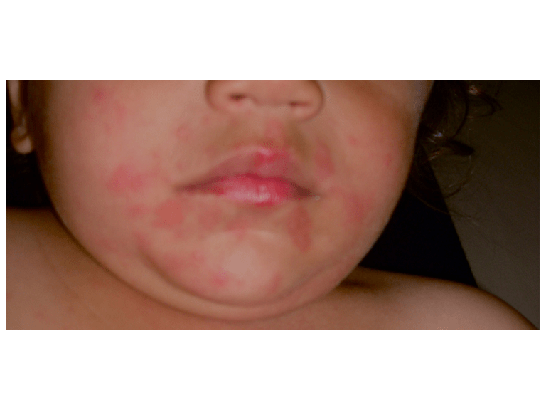 Anaphylaxis First Aid Training