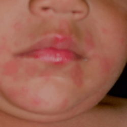 Anaphylaxis First Aid Training