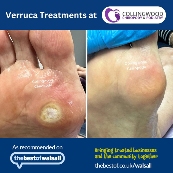 Veruca Treatments available at Collingwood Chiropody